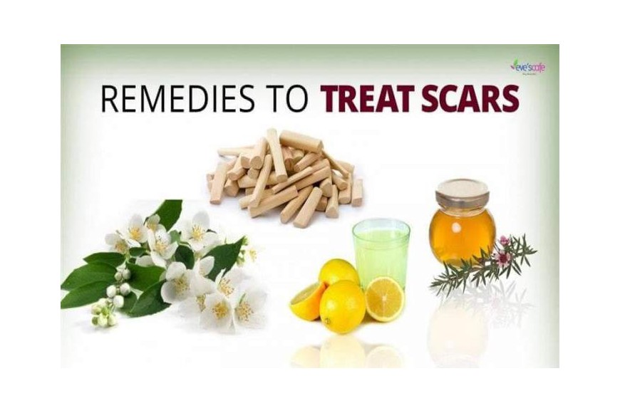 Evescafe | Home Remedies for Scars | Acne Scar Treatment