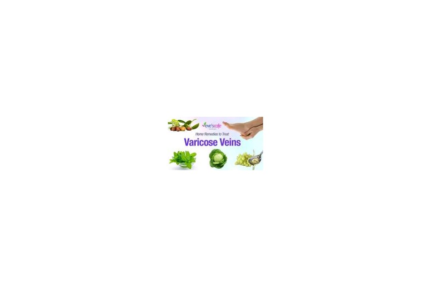 Natural Home Remedies to Cure Varicose Veins