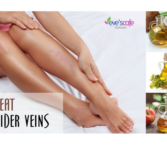 HOME REMEDIES FOR SPIDER VEINS | TREAT SPIDER VIENS @ HOME