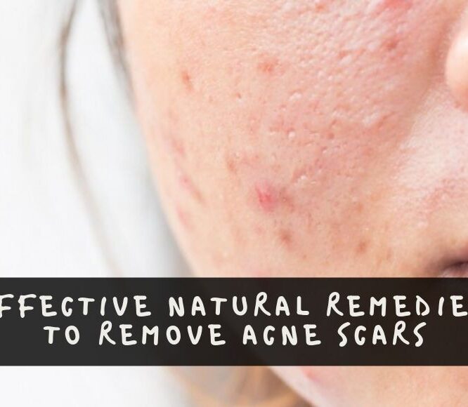 Effective Natural Remedies to Remove Acne Scars