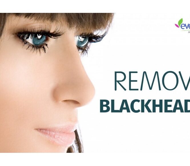 Remove Blackheads at Home – DIY