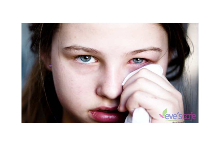 Evescafe | Causes and Symptoms of Eye Infections