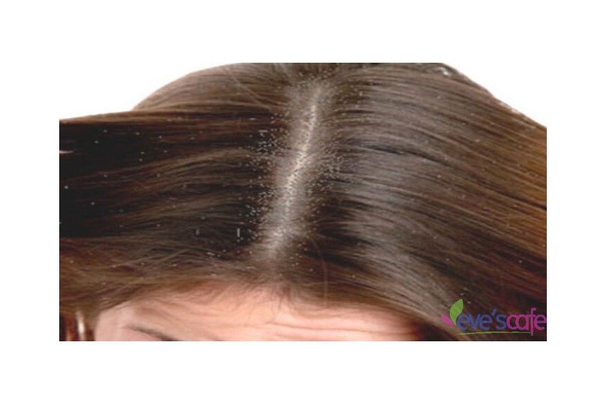 Evescafe | What causes Dandruff
